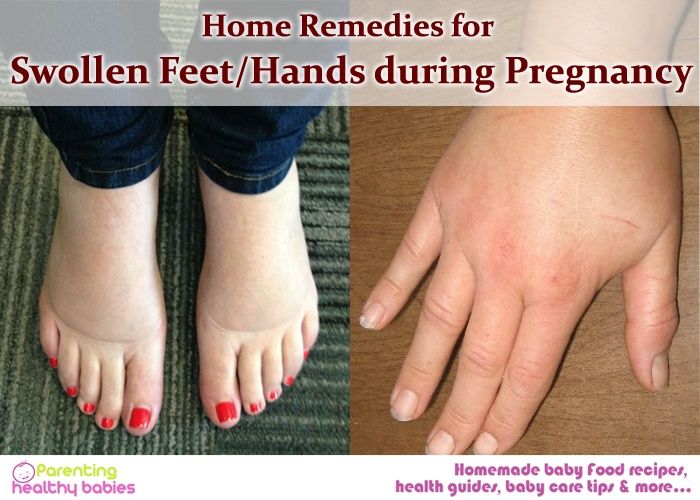 Read more about the article 妊娠中の手のしびれ、手の痛み、手のむくみ（手根管症候群）の悩み